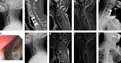 Bone resorption as a marker for delayed esophageal perforation post anterior cervical spine surgery: a retrospective analysis and call for increased vigilance